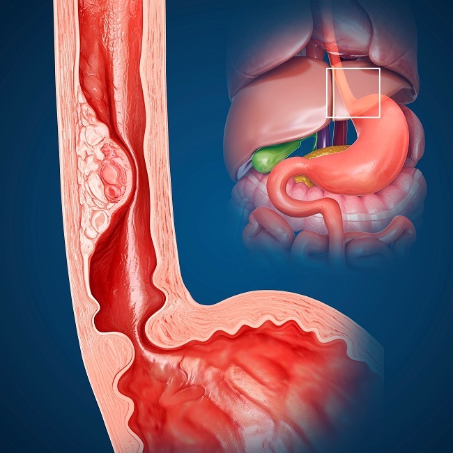 食管癌发生发展的机制及早期的诊断与治疗的研究进展2.jpg